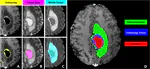 GBM-Reservoir - Dataset and Segmentations